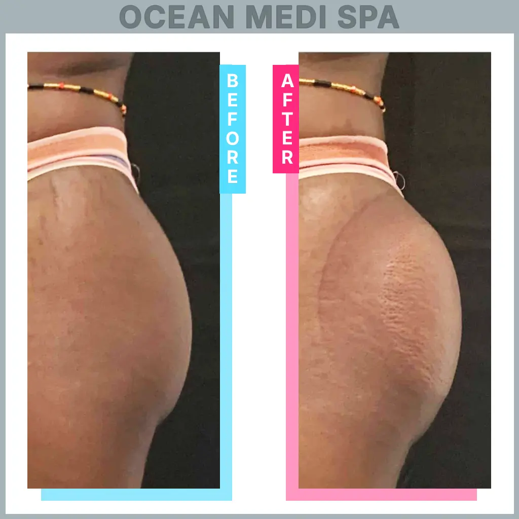ocean medi spa ajax - butt cupping before after 1 image